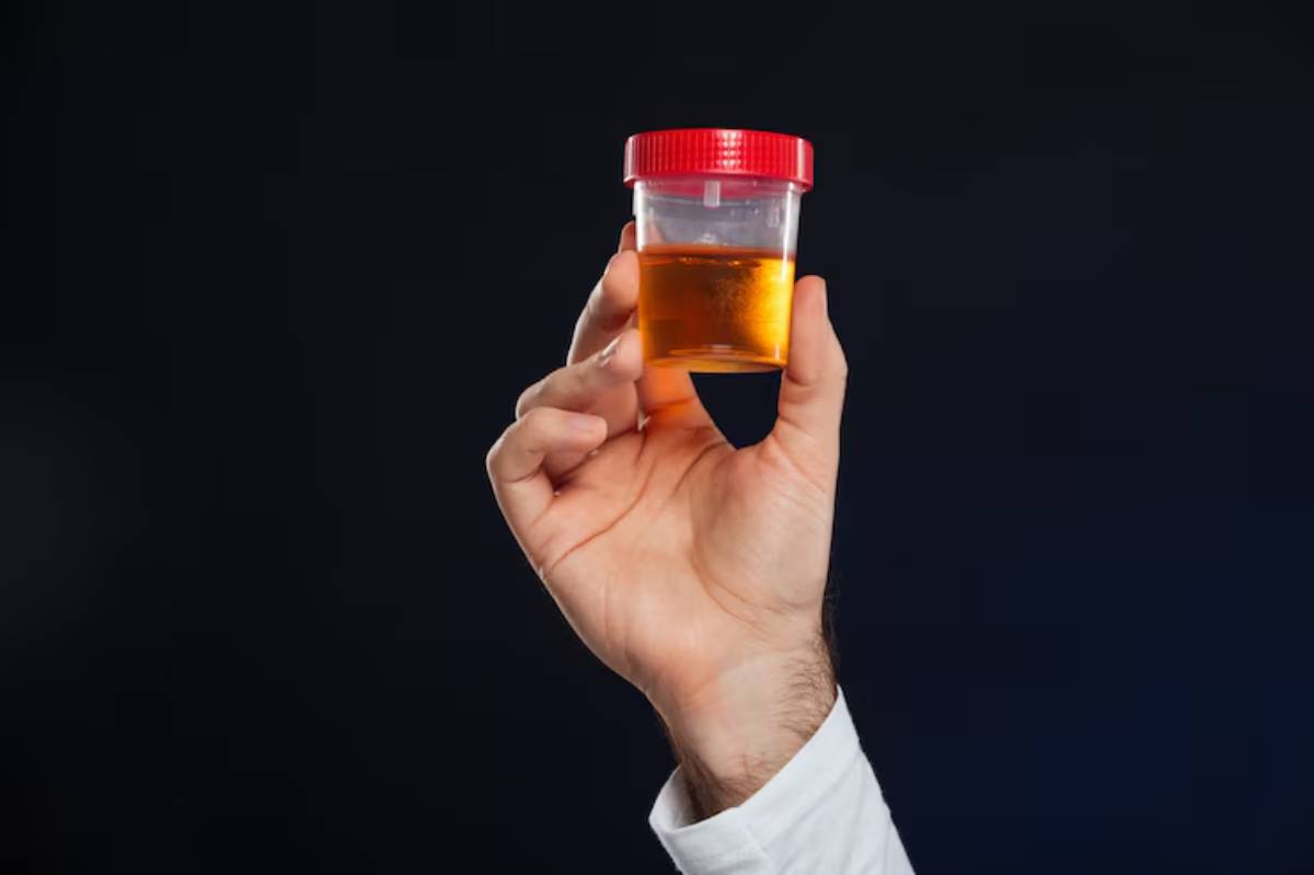 A hand holds a transparent container with yellow liquid and a red lid against a dark background, possibly indicating a urine sample.